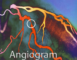 Angiogram